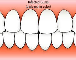 infected gums