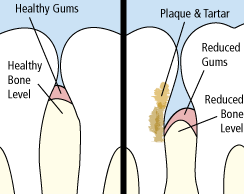 periodontitis gums