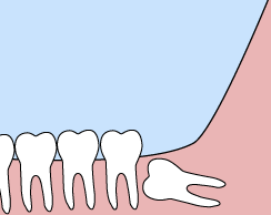 wisdom teeth